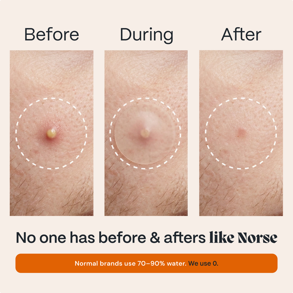 Acne Patches with Arctic Herbs