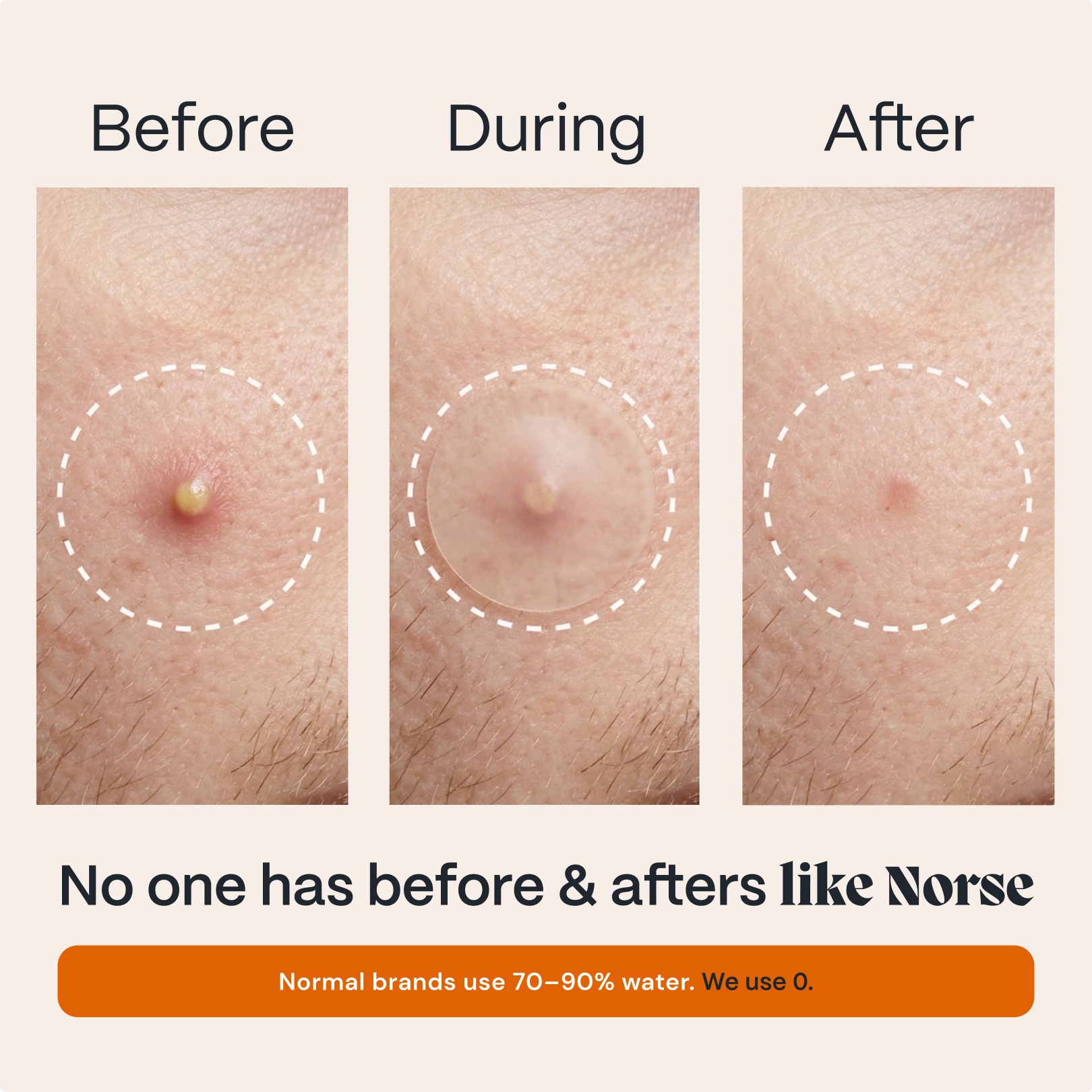 Acne Patches with Arctic Herbs