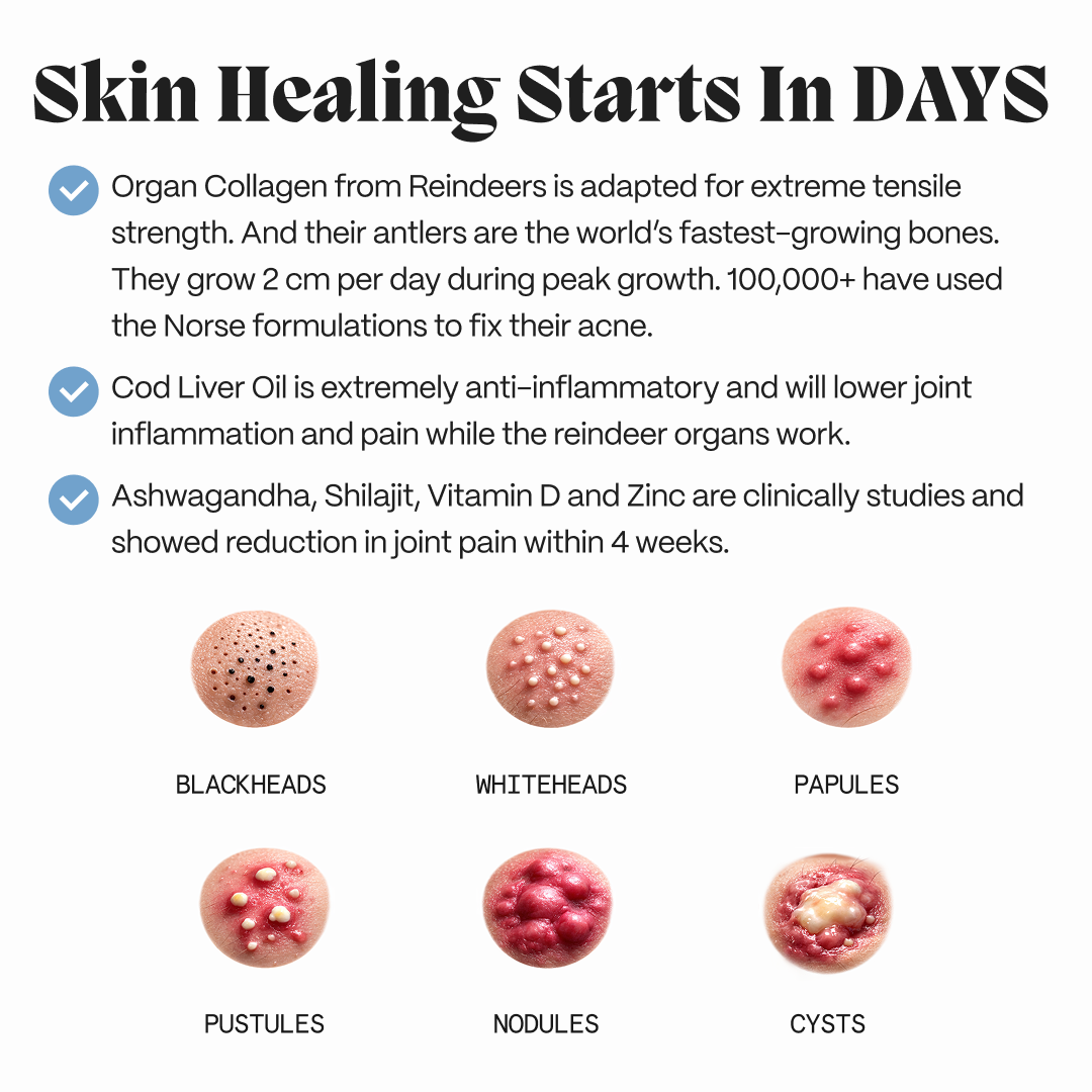 Complete Gut Repair & Hormonal Balance System for Female Acne