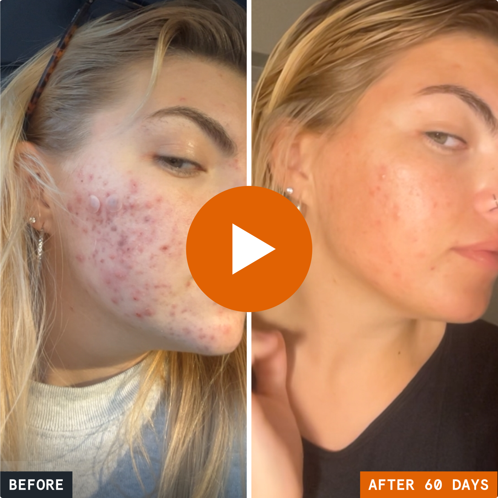 Kill Acne & Redness Ritual