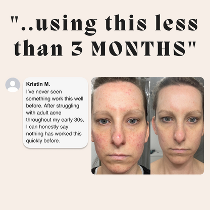 Complete Gut Repair & Hormonal Balance System for Female Acne