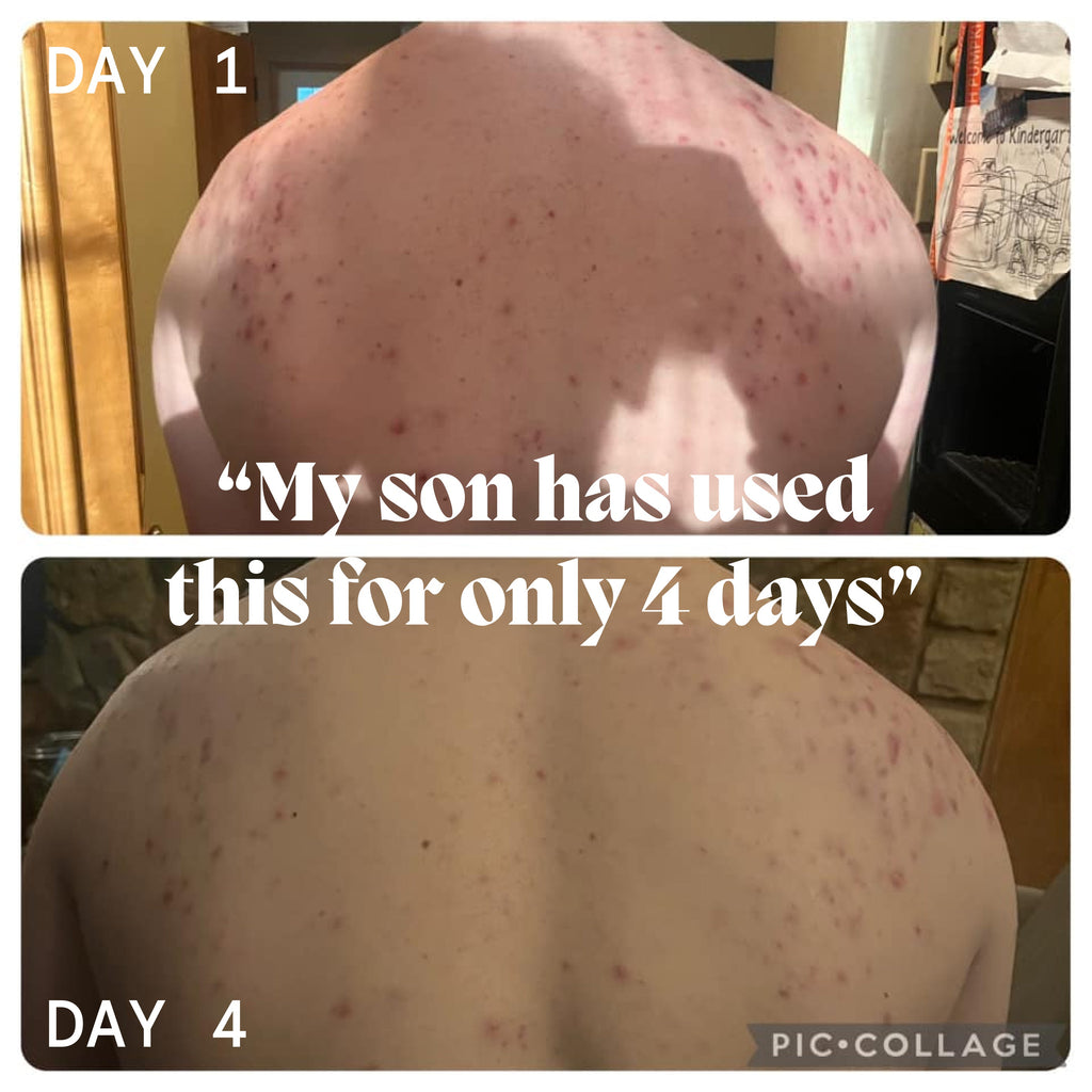 Body Balm for Acne Prone Skin