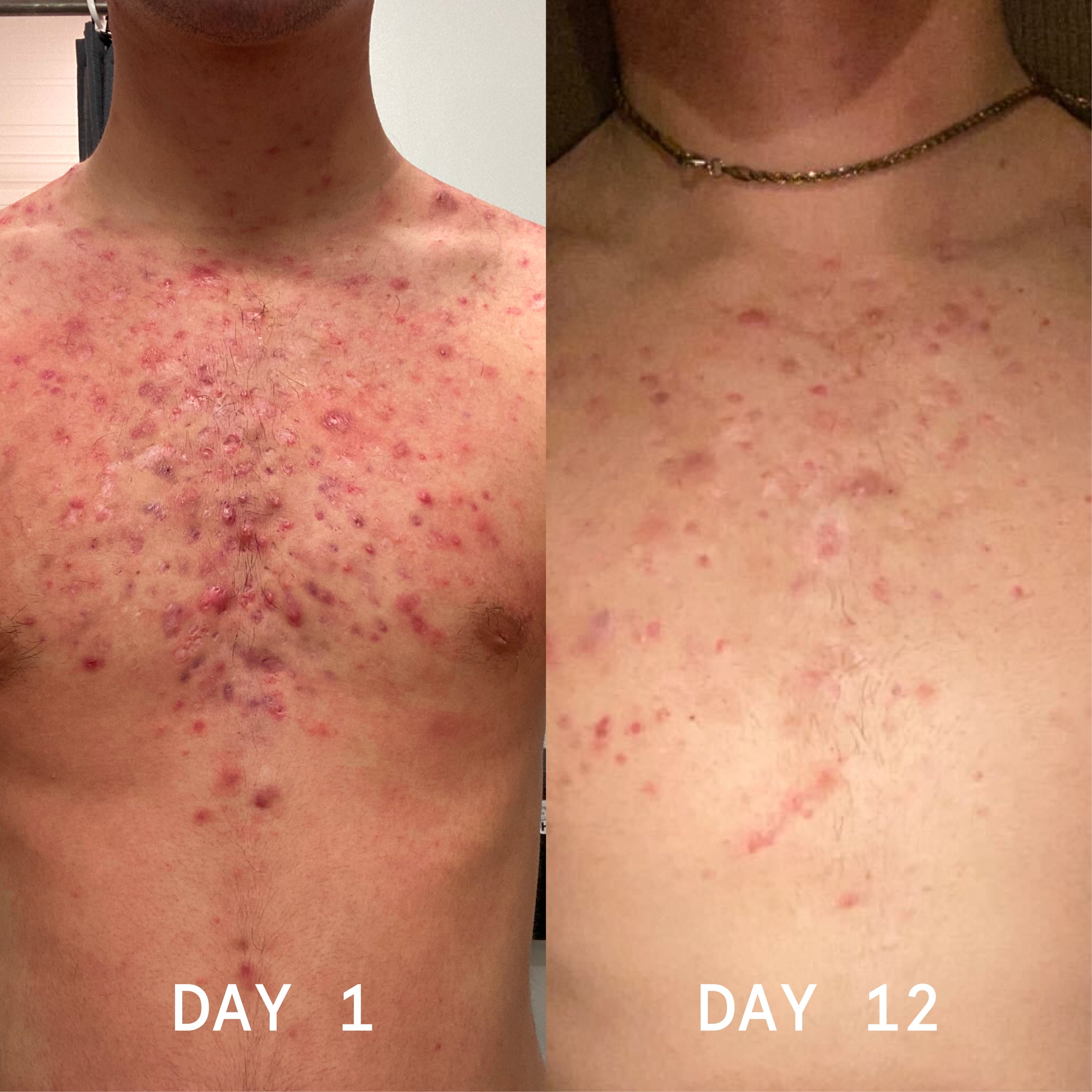 Body Balm for Acne Prone Skin